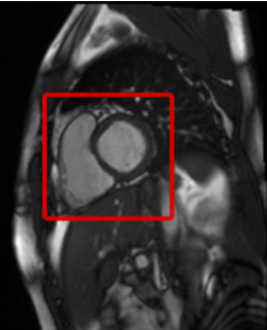 Automated Heart Localization in Cardiac Cine MR Data